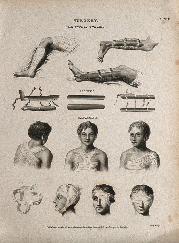 Illustration einer alten Buchseite mit einem Mannsbeinen und einem Frauenkopf mit Verbandköpfen, begleitet von einem Text über eine Operation.